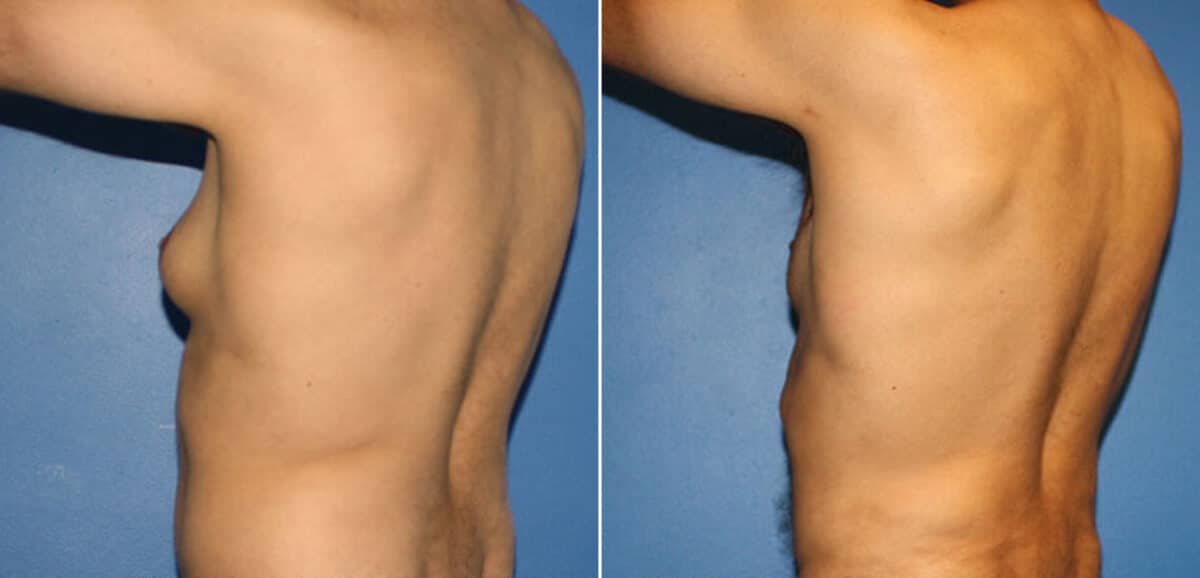 Body Banking Before and After Photos in New York, NY, Patient 16213