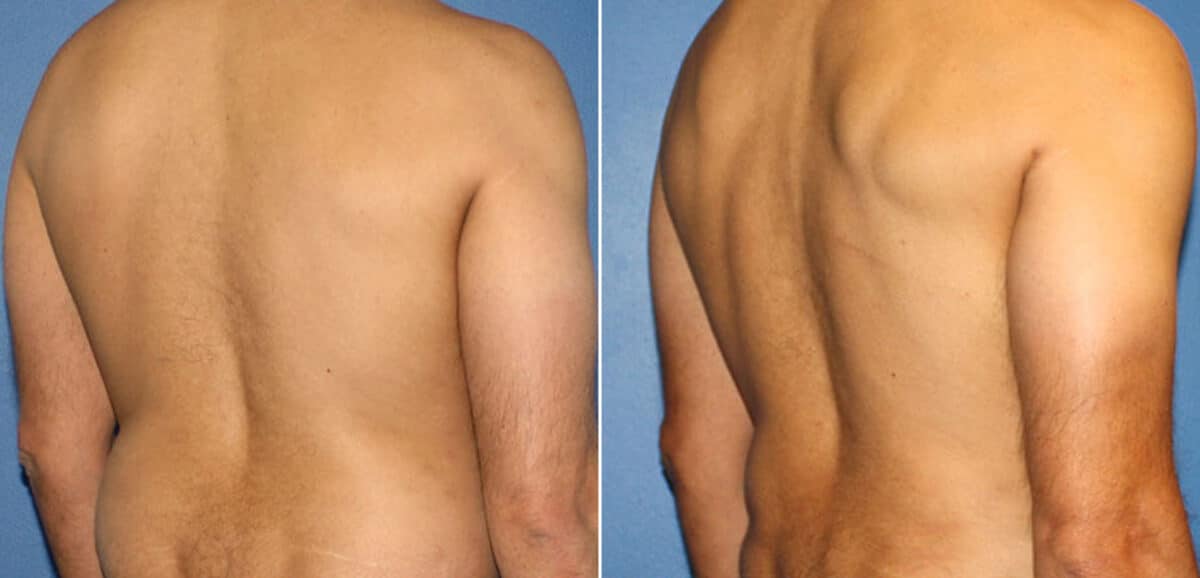 Body Banking Before and After Photos in New York, NY, Patient 16213