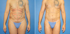 Body Banking Before and After Photos in New York, NY, Patient 16113