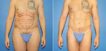 Body Banking Before and After Photos in New York, NY, Patient 16113