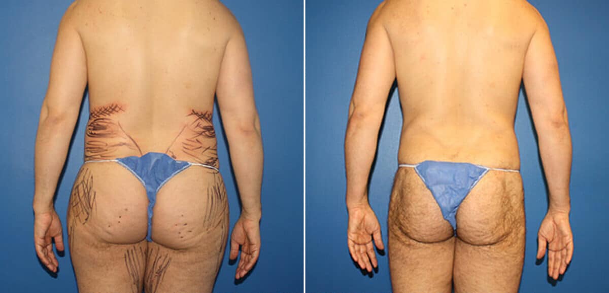 Body Banking Before and After Photos in New York, NY, Patient 16113