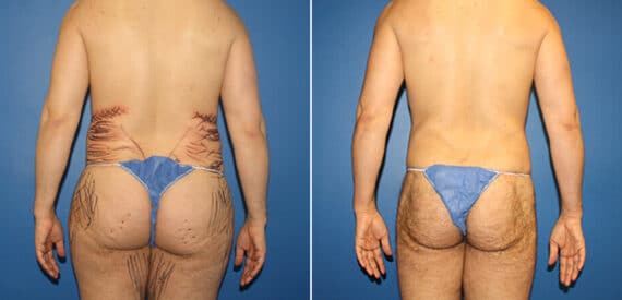 Body Banking Before and After Photos in New York, NY, Patient 16113