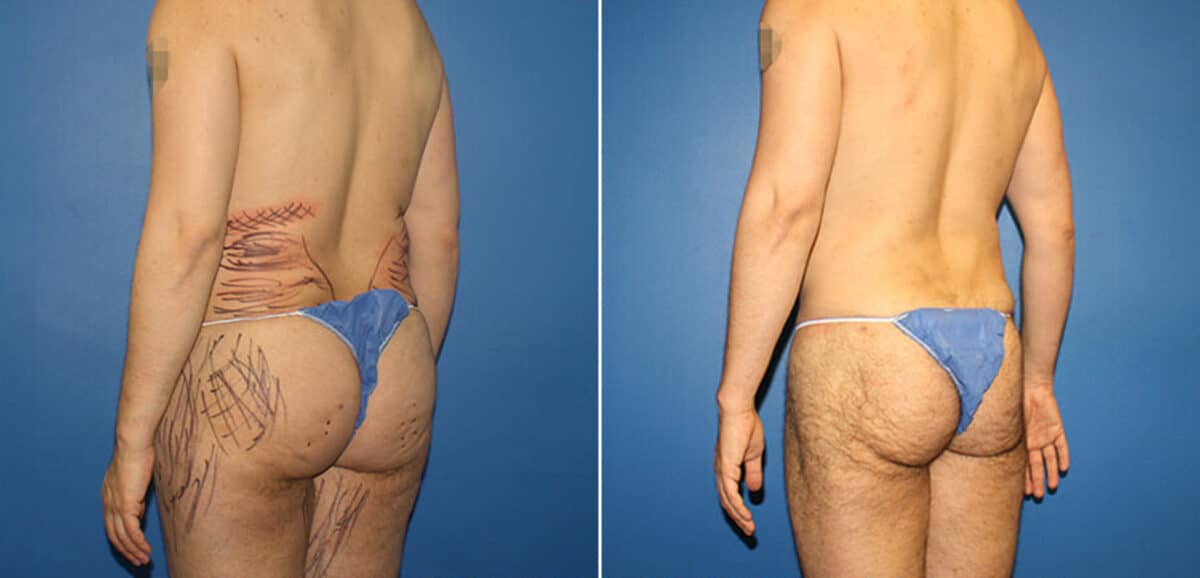 Body Banking Before and After Photos in New York, NY, Patient 16113