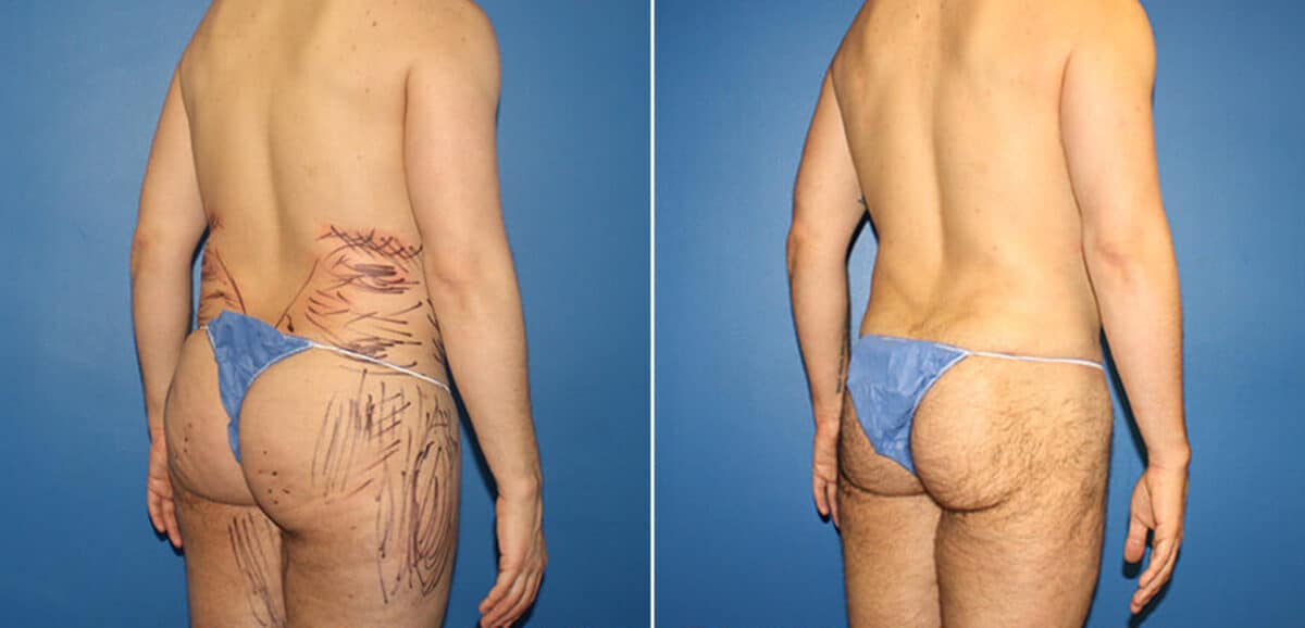 Body Banking Before and After Photos in New York, NY, Patient 16113