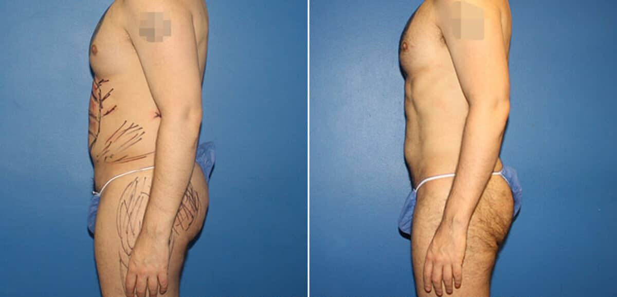 Body Banking Before and After Photos in New York, NY, Patient 16113