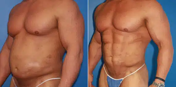 Liposuction Before and After Photos in New York, NY, Patient 16031