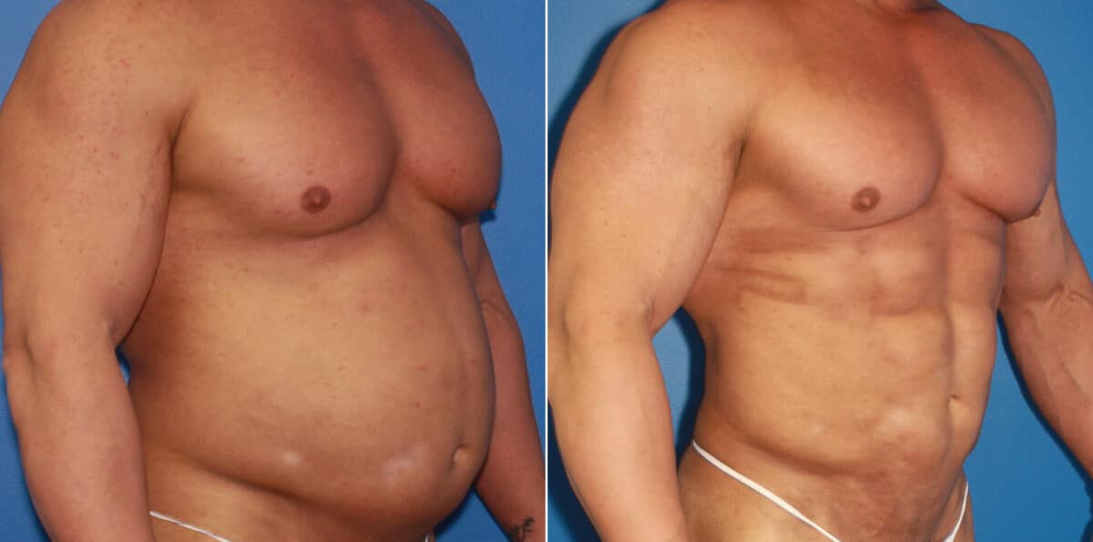 Body Banking Before and After Photos in New York, NY, Patient 16031
