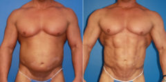 Liposuction Before and After Photos in New York, NY, Patient 16031