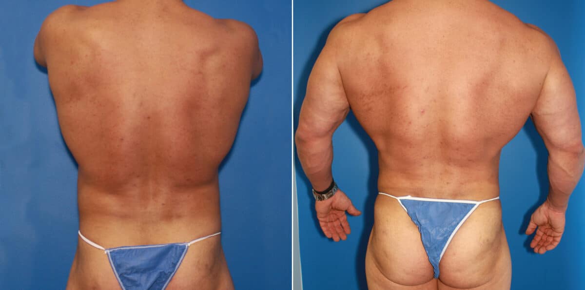 Body Banking Before and After Photos in New York, NY, Patient 16031
