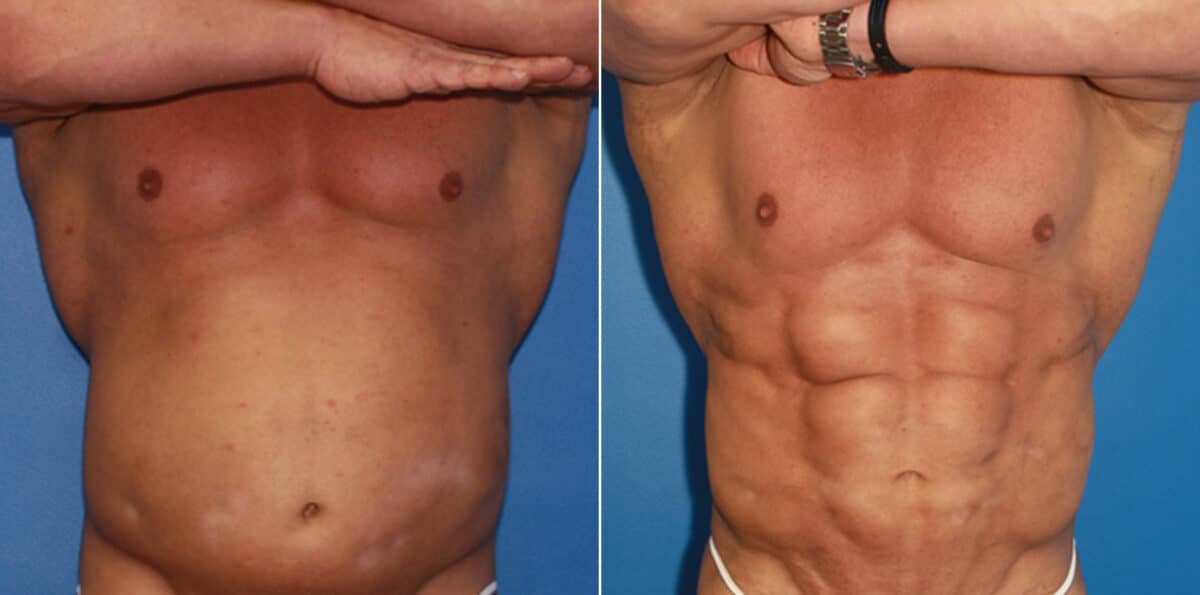 Body Banking Before and After Photos in New York, NY, Patient 16031