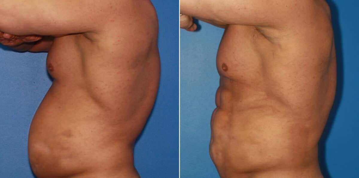 Body Banking Before and After Photos in New York, NY, Patient 16031