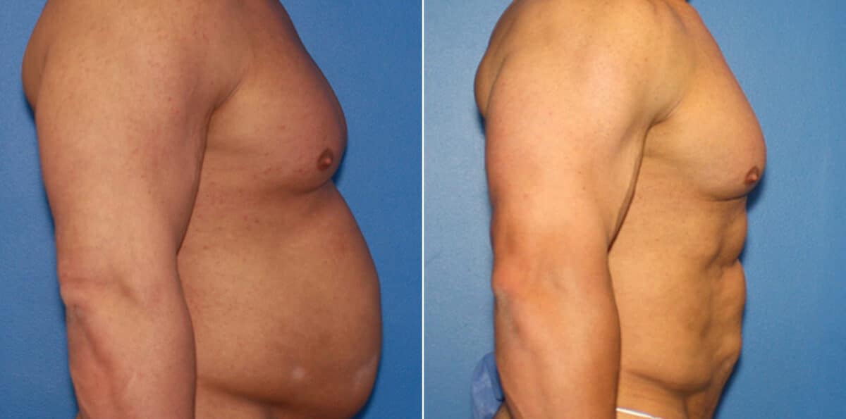 Body Banking Before and After Photos in New York, NY, Patient 16031