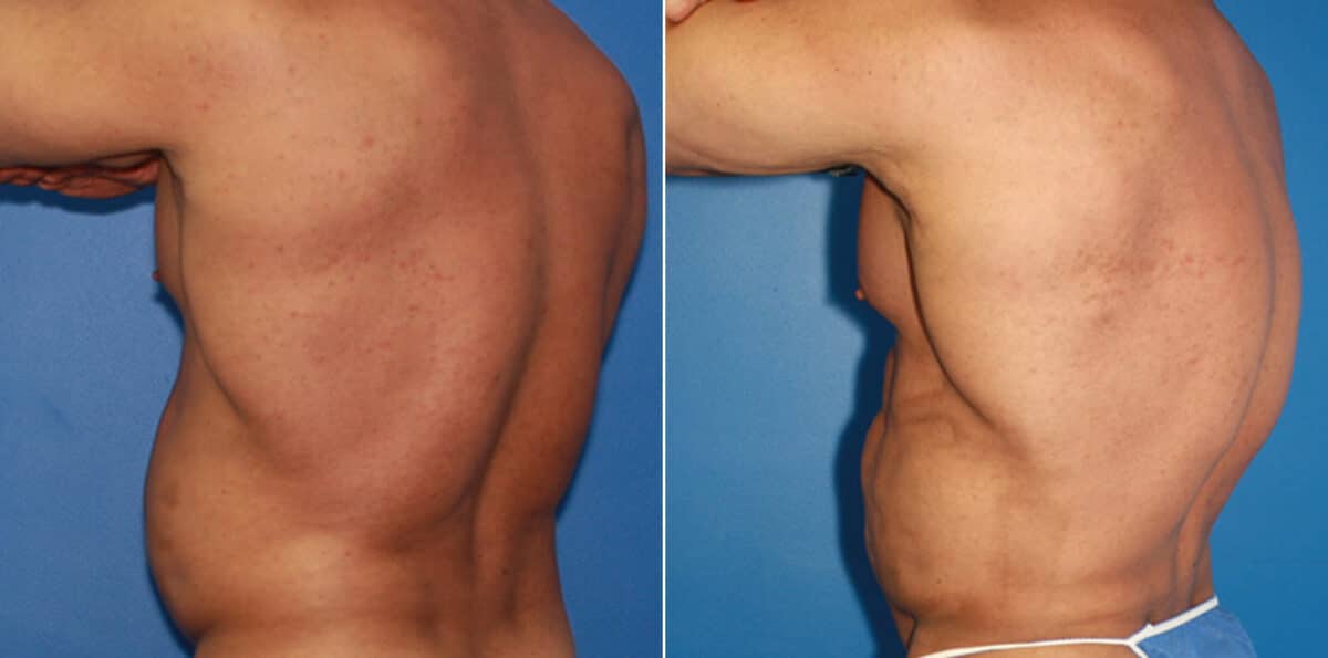 Body Banking Before and After Photos in New York, NY, Patient 16031