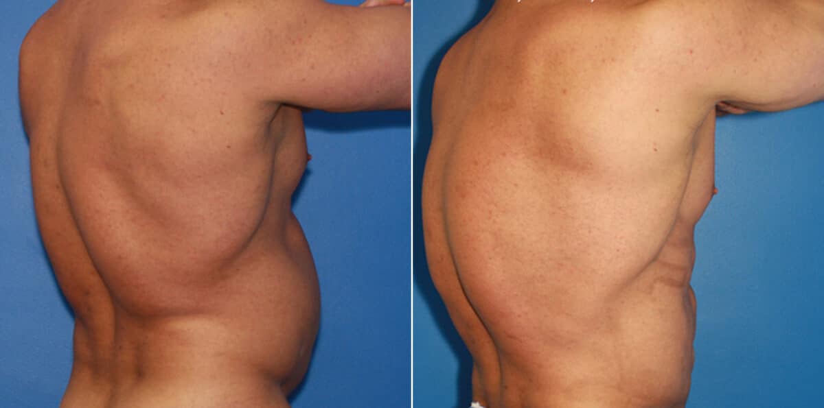 Body Banking Before and After Photos in New York, NY, Patient 16031