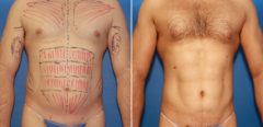 Liposuction Before and After Photos in New York, NY, Patient 16073