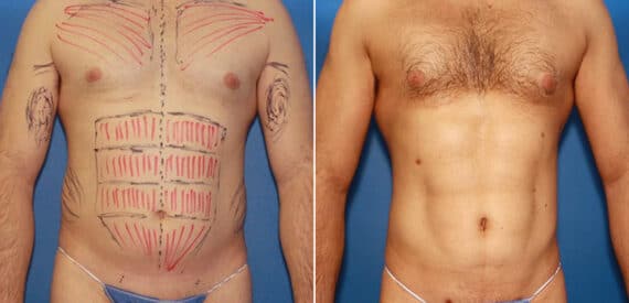 Liposuction Before and After Photos in New York, NY, Patient 16073