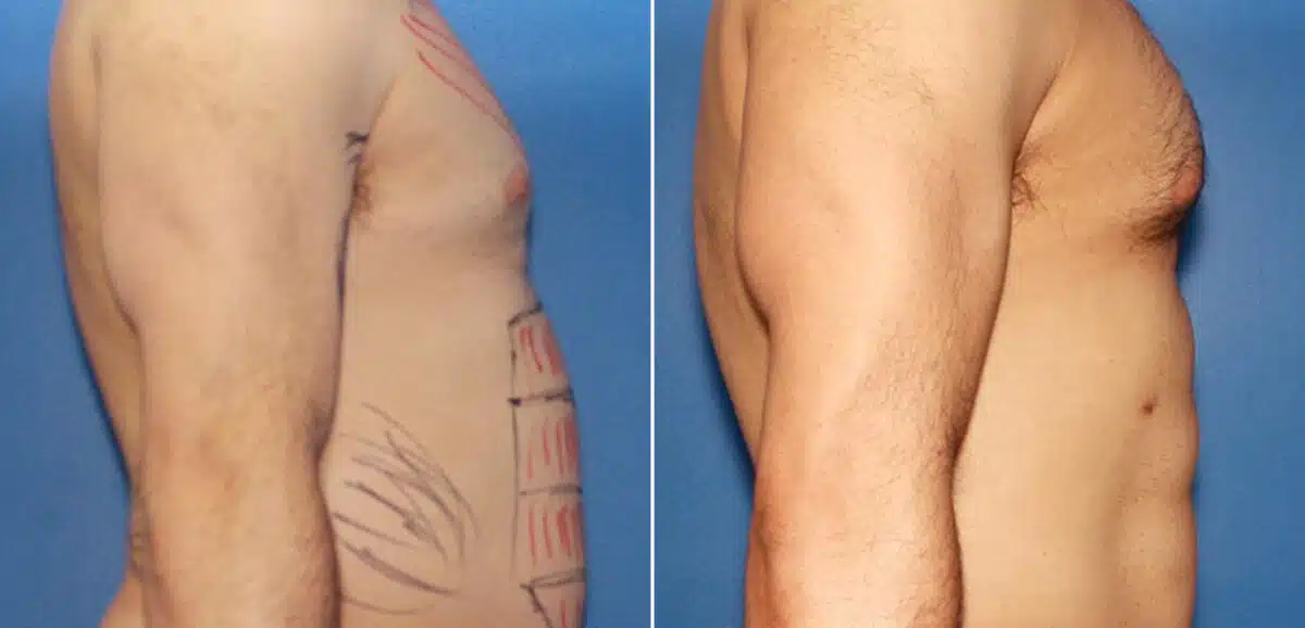 Body Banking Before and After Photos in New York, NY, Patient 16073