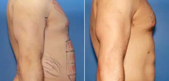 Liposuction Before and After Photos in New York, NY, Patient 16073