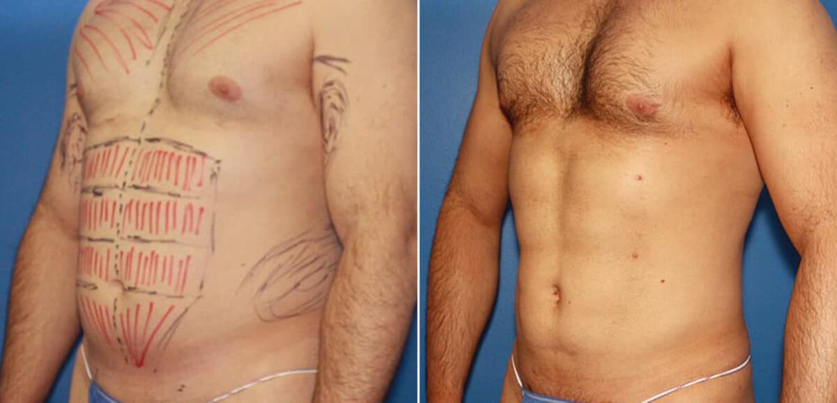 Body Banking Before and After Photos in New York, NY, Patient 16073