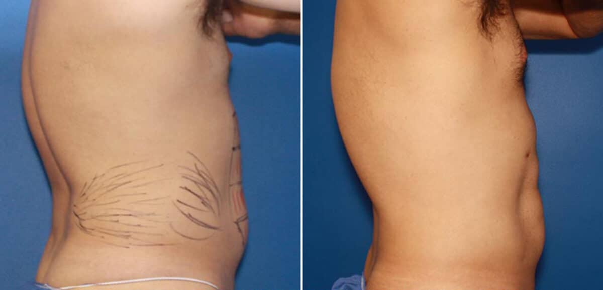 Body Banking Before and After Photos in New York, NY, Patient 16073