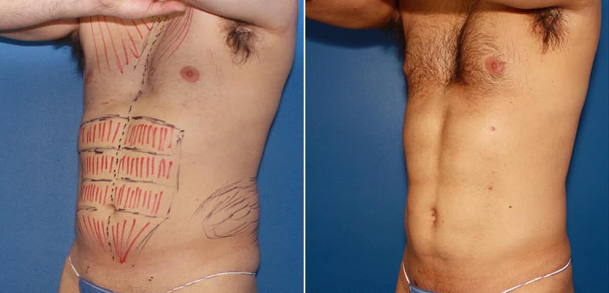 Body Banking Before and After Photos in New York, NY, Patient 16073