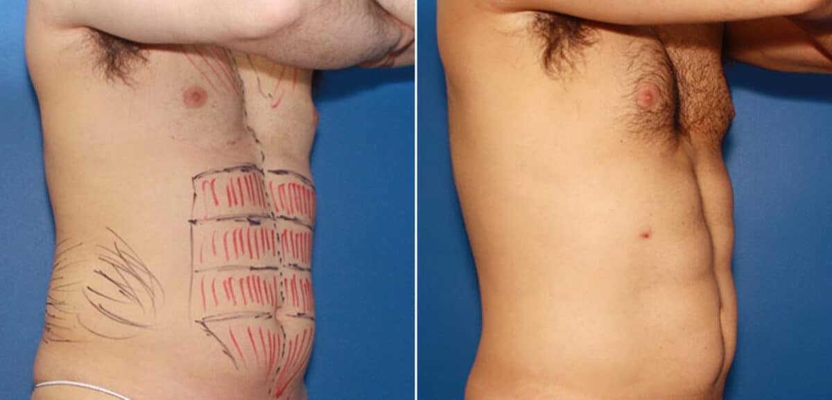 Body Banking Before and After Photos in New York, NY, Patient 16073