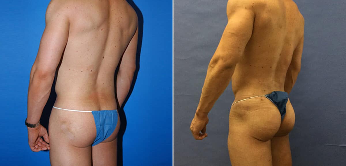 Gluteal Augmentation Before and After Photos in New York, NY, Patient 16464