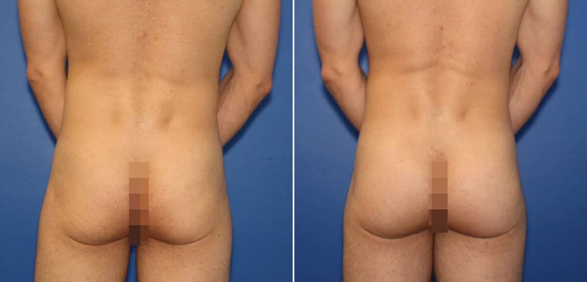 Gluteal Augmentation Before and After Photos in New York, NY, Patient 16496