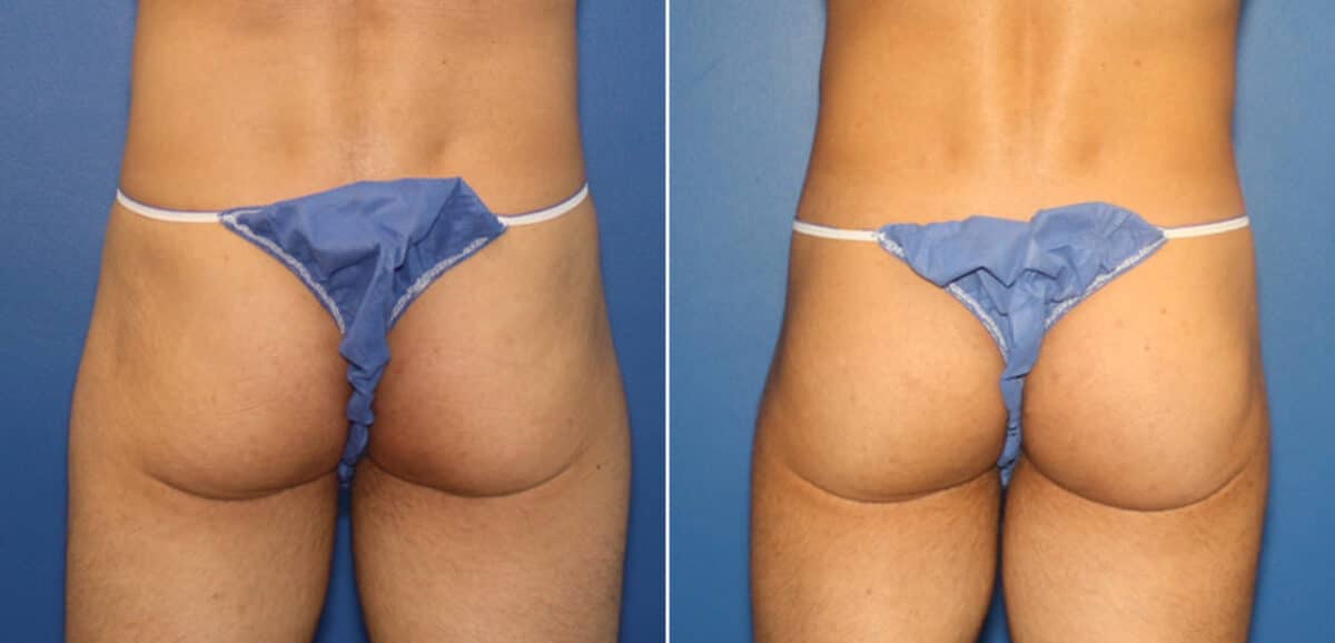 Gluteal Augmentation Before and After Photos in New York, NY, Patient 16496