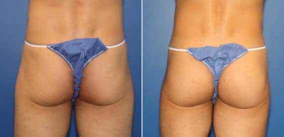 Gluteal Augmentation Before and After Photos in New York, NY, Patient 16496