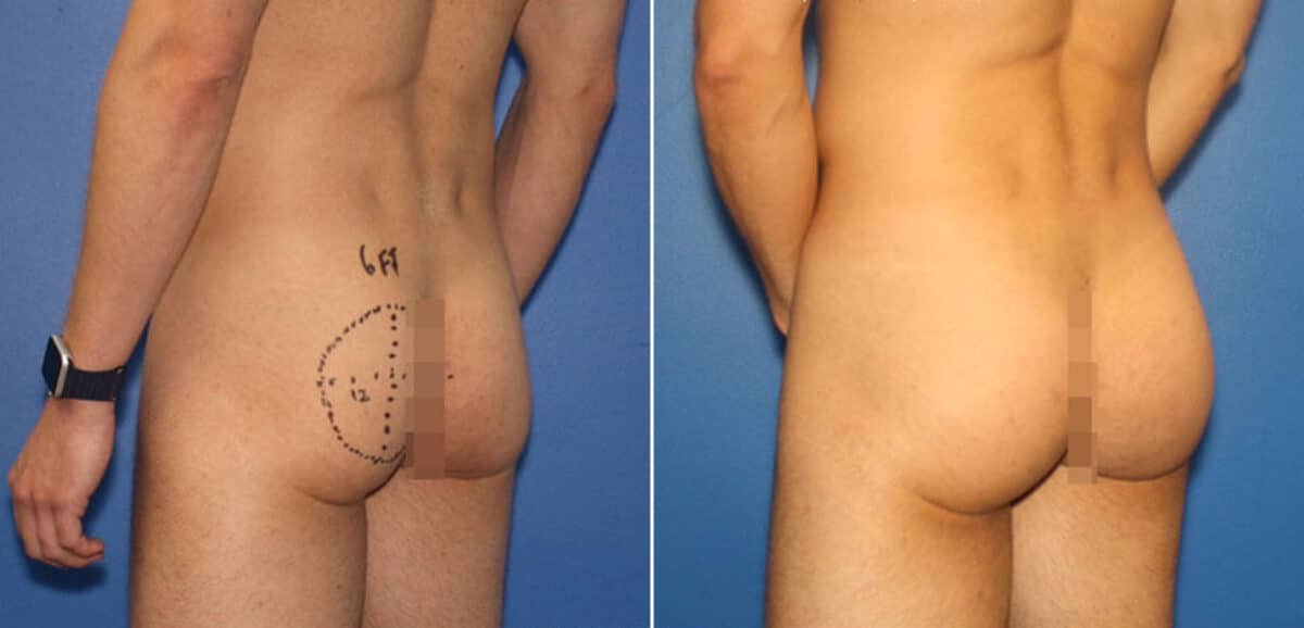 Gluteal Augmentation Before and After Photos in New York, NY, Patient 16496