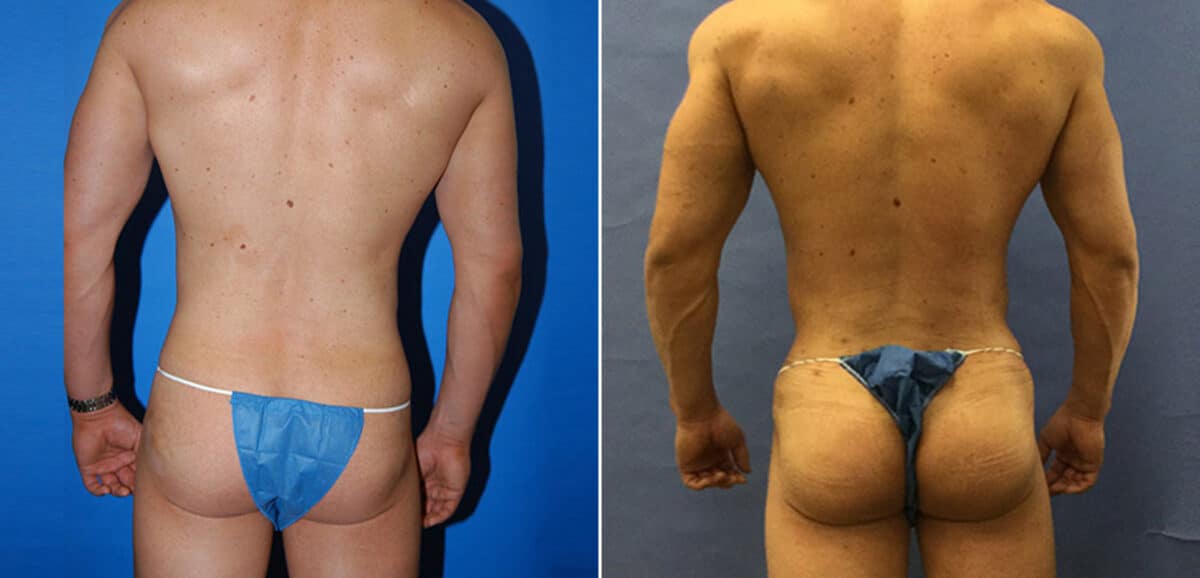 Gluteal Augmentation Before and After Photos in New York, NY, Patient 16464