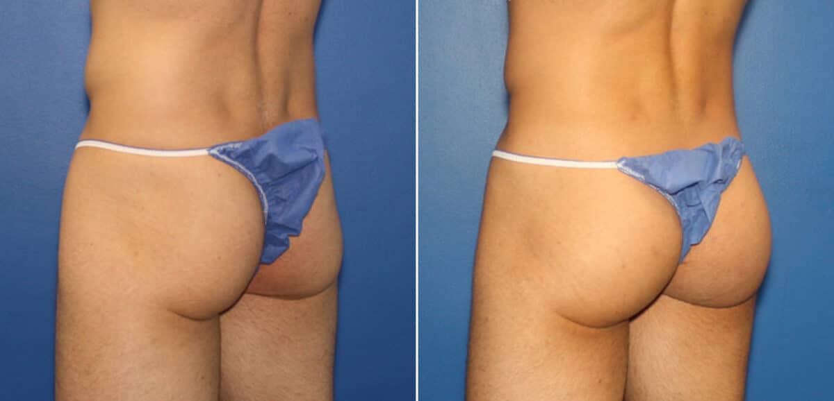 Gluteal Augmentation Before and After Photos in New York, NY, Patient 16496