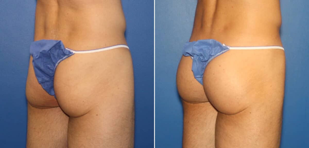 Gluteal Augmentation Before and After Photos in New York, NY, Patient 16496