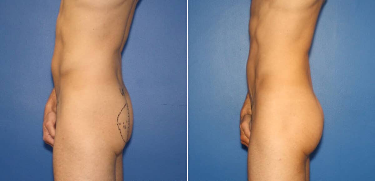 Gluteal Augmentation Before and After Photos in New York, NY, Patient 16496