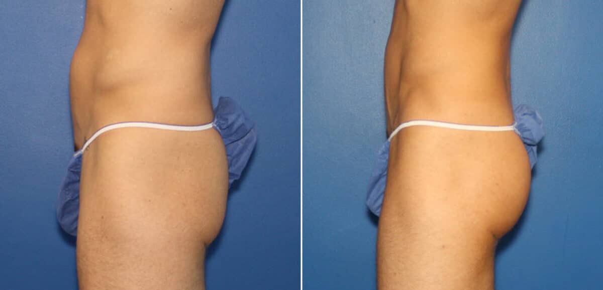 Gluteal Augmentation Before and After Photos in New York, NY, Patient 16496