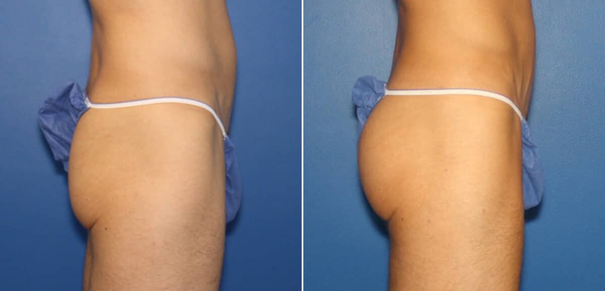 Gluteal Augmentation Before and After Photos in New York, NY, Patient 16496