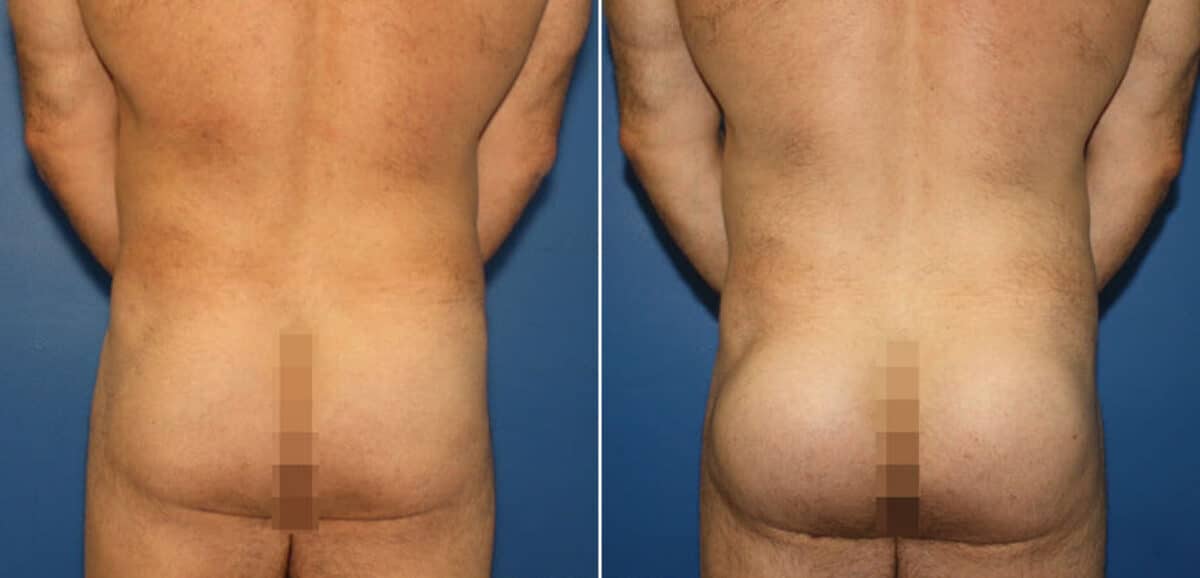 Gluteal Augmentation Before and After Photos in New York, NY, Patient 16524