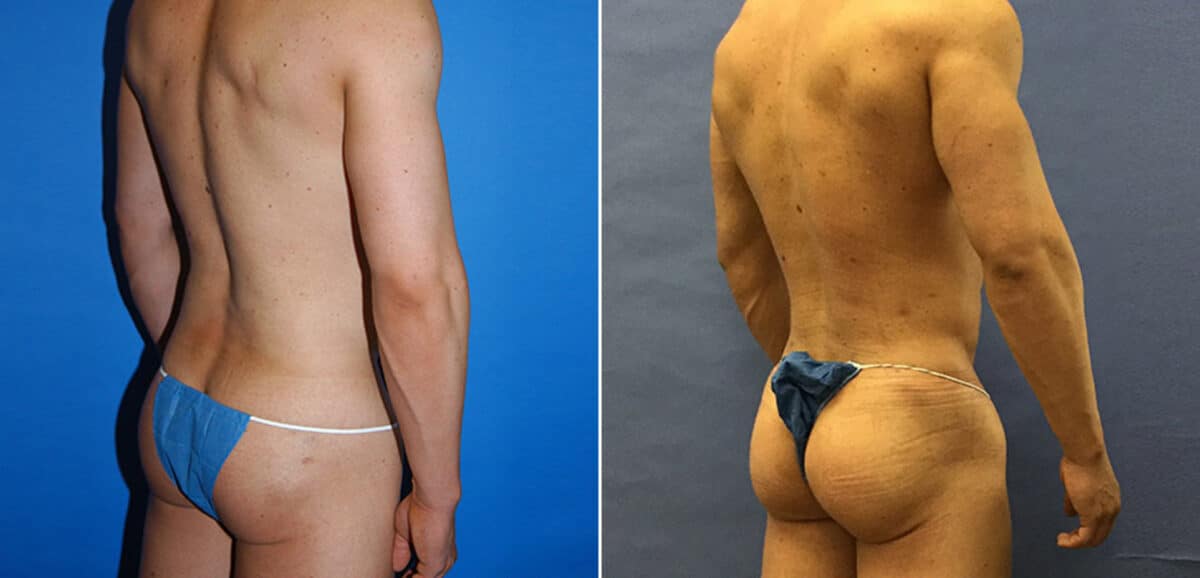 Gluteal Augmentation Before and After Photos in New York, NY, Patient 16464