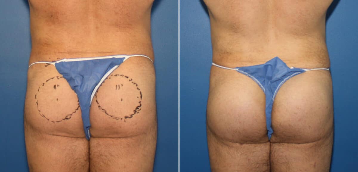 Gluteal Augmentation Before and After Photos in New York, NY, Patient 16524