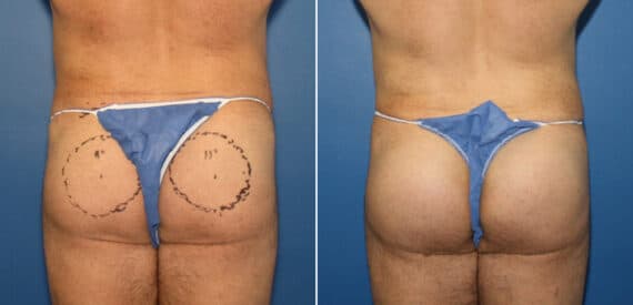 Gluteal Augmentation Before and After Photos in New York, NY, Patient 16524
