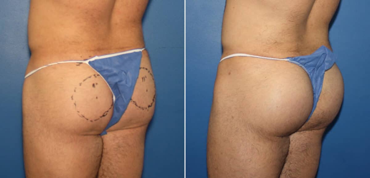 Gluteal Augmentation Before and After Photos in New York, NY, Patient 16524