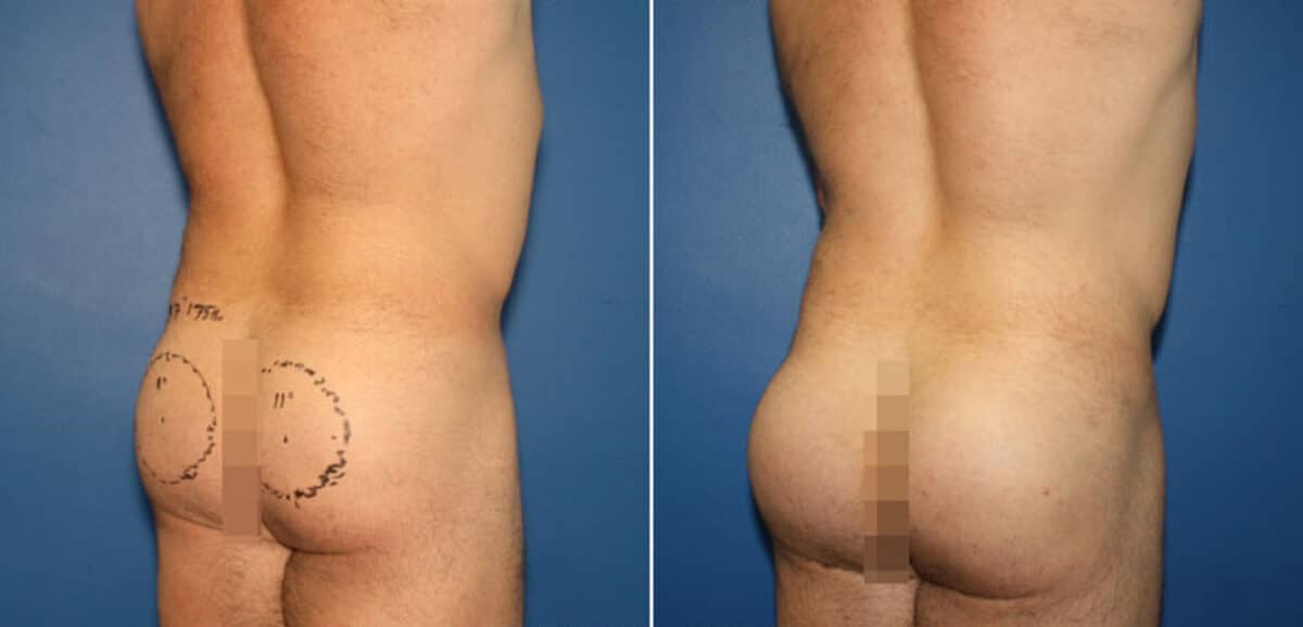 Gluteal Augmentation Before and After Photos in New York, NY, Patient 16524
