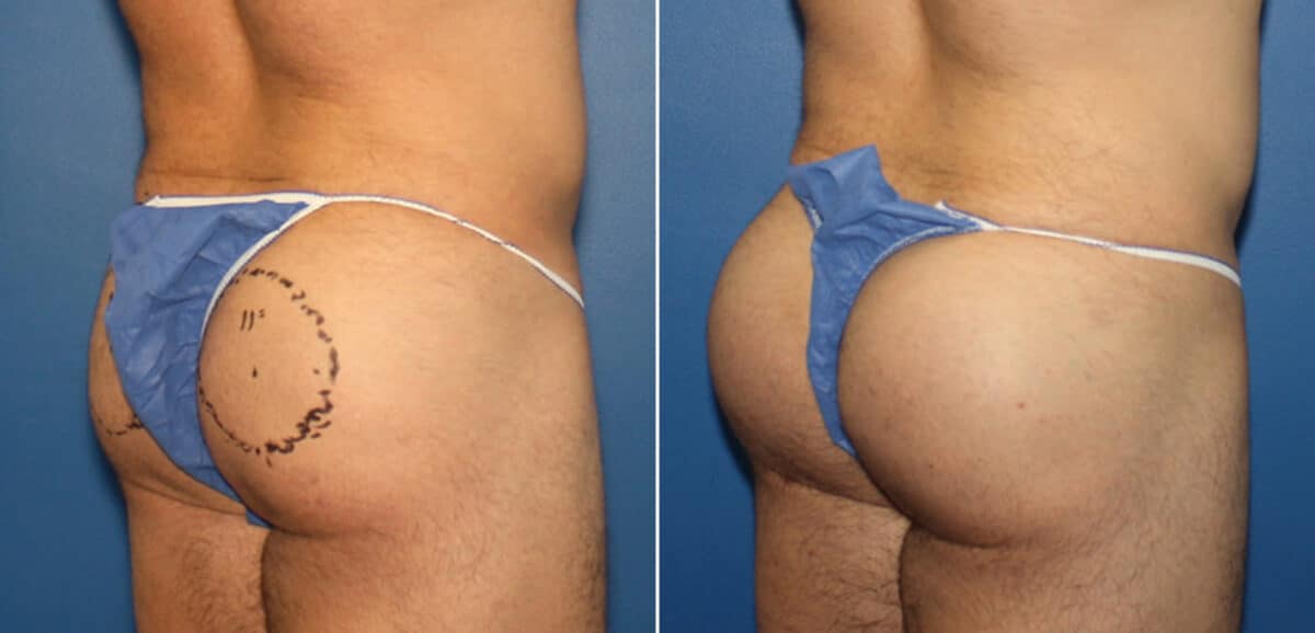 Gluteal Augmentation Before and After Photos in New York, NY, Patient 16524