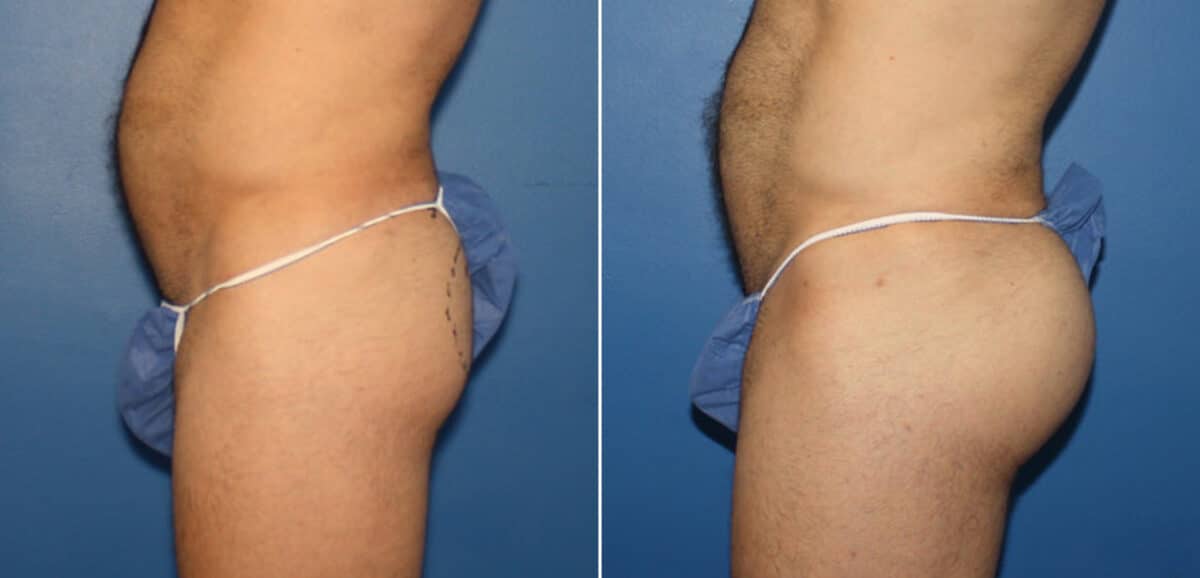Gluteal Augmentation Before and After Photos in New York, NY, Patient 16524