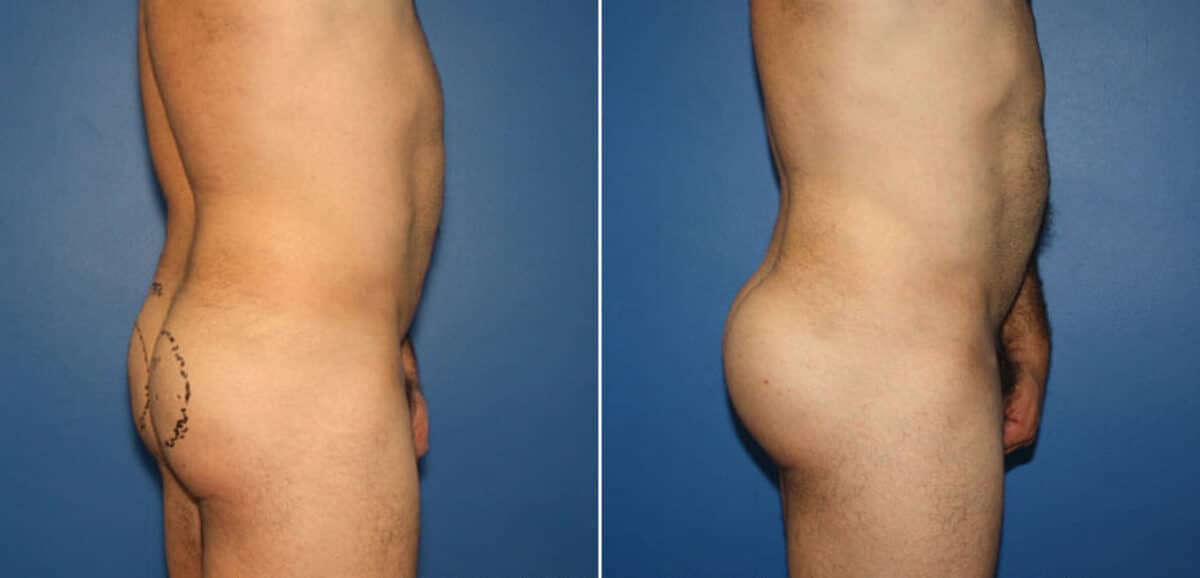 Gluteal Augmentation Before and After Photos in New York, NY, Patient 16524
