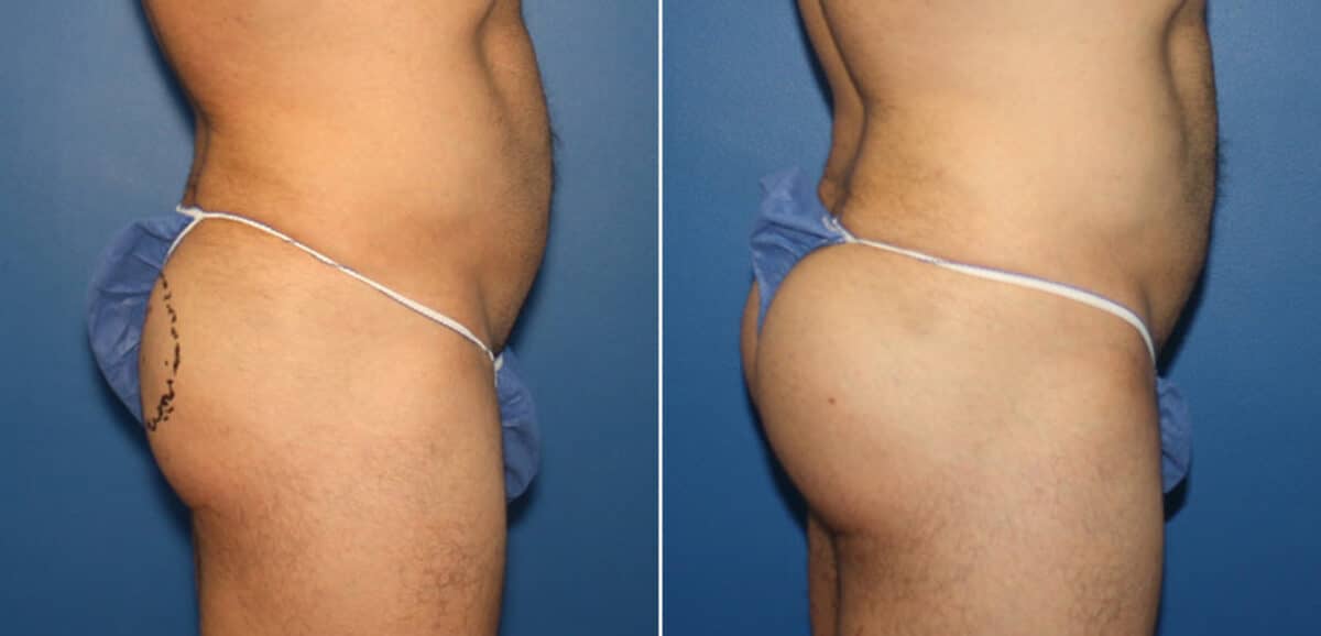 Gluteal Augmentation Before and After Photos in New York, NY, Patient 16524