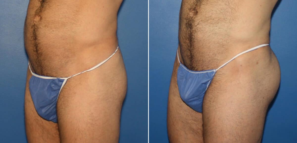 Gluteal Augmentation Before and After Photos in New York, NY, Patient 16524