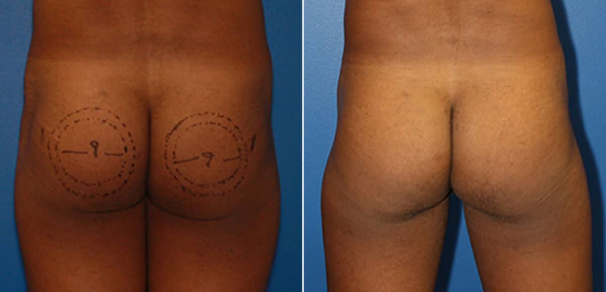 Gluteal Augmentation Before and After Photos in New York, NY, Patient 16552