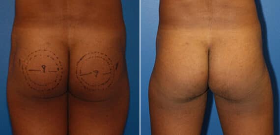 Gluteal Augmentation Before and After Photos in New York, NY, Patient 16552